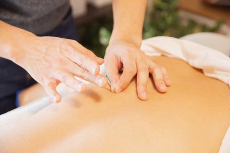 Read more about the article Acupuncture – More Than Just Pins And Needles